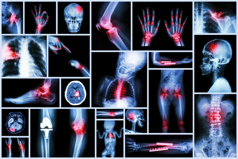 Pain and Arthritis in Lyme Disease - Dr. Todd Maderis